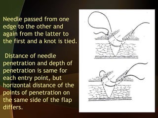 Needle passed from one
edge to the other and
again from the latter to
the first and a knot is tied.
Distance of needle
penetration and depth of
penetration is same for
each entry point, but
horizontal distance of the
points of penetration on
the same side of the flap
differs.
 
