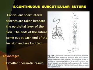 8.CONTINUOUS SUBCUTICULAR SUTURE
Continuous short lateral
stitches are taken beneath
the epithelial layer of the
skin. The ends of the suture
come out at each end of the
incision and are knotted.
Advantages
 Excellent cosmetic result.
 