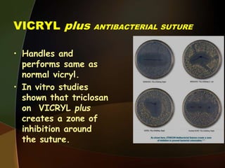 VICRYL plus ANTIBACTERIAL SUTURE
• Handles and
performs same as
normal vicryl.
• In vitro studies
shown that triclosan
on VICRYL plus
creates a zone of
inhibition around
the suture.
 