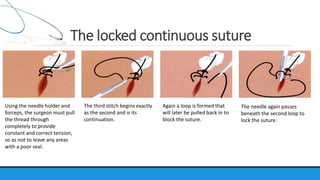 Looped Suture Use Suture material & suturing technique | PPTX