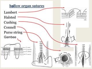 Sture Pattern suture patterns , types , uses and tools | PPTX