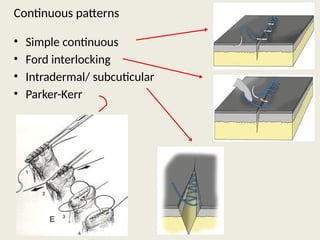 suture patterns , types , uses and tools | PPTX