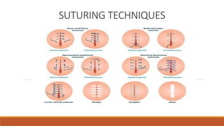 Comprehensive Guide to Suture Materials and Suturing Techniques in ...