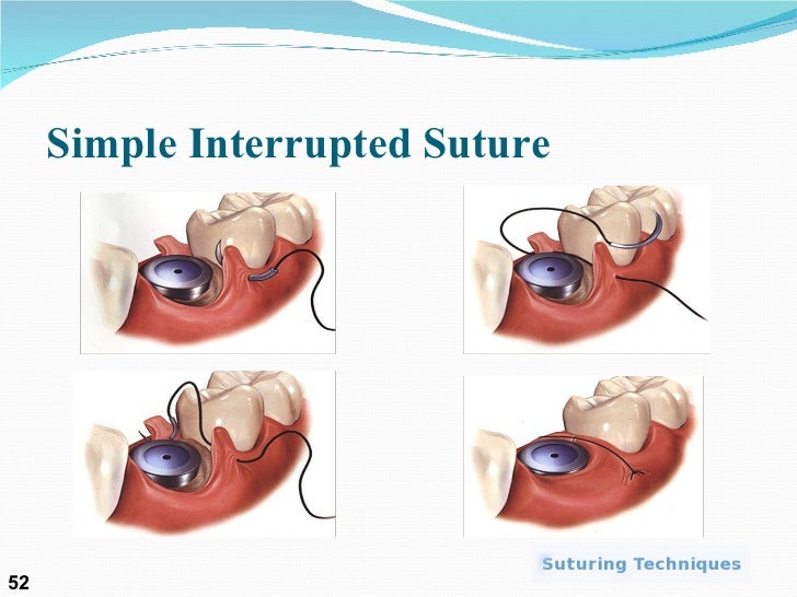 Suture presentation by Dr. Nabeel ur Rehman and Dr. Suneel Maghnani
