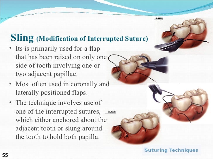 Suture presentation by Dr. Nabeel ur Rehman and Dr. Suneel Maghnani