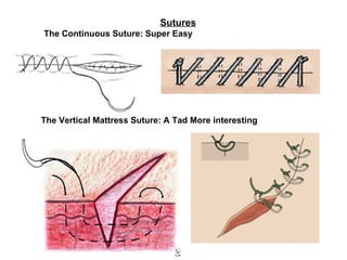 Sutures   The Continuous Suture: Super Easy   The Vertical Mattress Suture: A Tad More interesting   