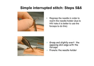 Simple interrupted stitch: Steps 5&6
• Regrasp the needle in order to
rearm the needle-holder (due to
HIV risks it is better to use the
forceps to do this)
Grasp and slightly evert the
opposing skin edge with the
forceps
Pronate the needle-holder
 