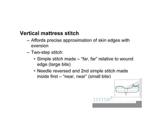 Vertical mattress stitch
– Affords precise approximation of skin edges with
eversion
– Two-step stitch:
• Simple stitch made – “far, far” relative to wound
edge (large bite)
• Needle reversed and 2nd simple stitch made
inside first – “near, near” (small bite)
 