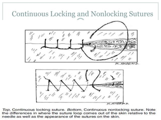 Continuous Locking and Nonlocking Sutures

 