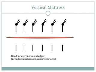 Vertical Mattress

Good for everting wound edges
(neck, forehead creases, concave surfaces)

 