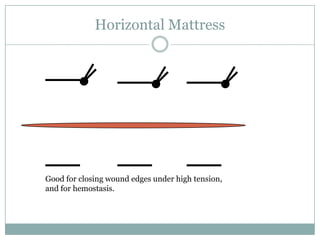 Horizontal Mattress

Good for closing wound edges under high tension,
and for hemostasis.

 