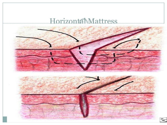Sutures and suturing patterns in surgery & modern innovations | PPT