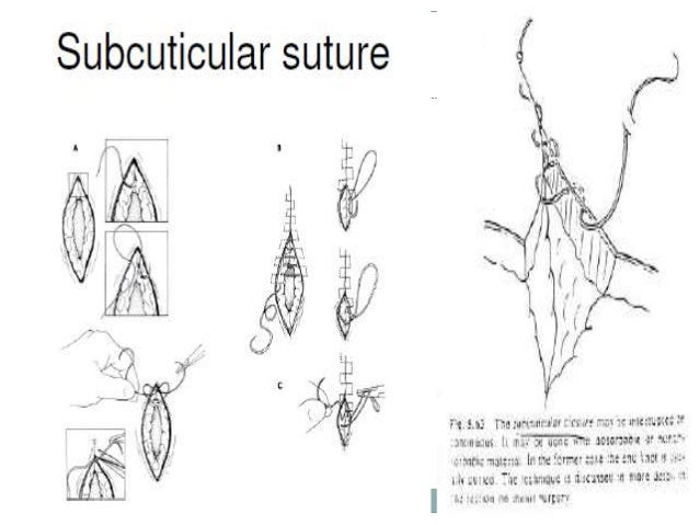 suture patterns