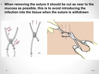 Sutures emad
