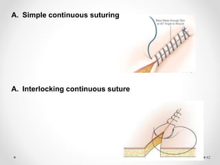 Sutures emad