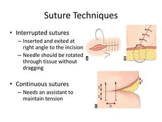 Sutures in surgery