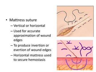 Sutures in surgery