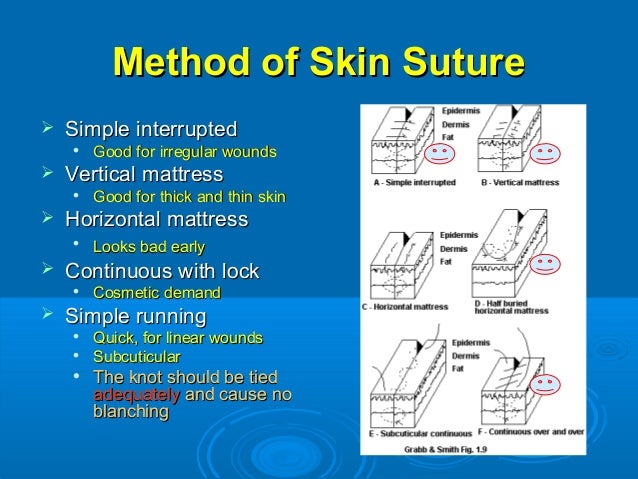 Suture Materials Comparison Chart