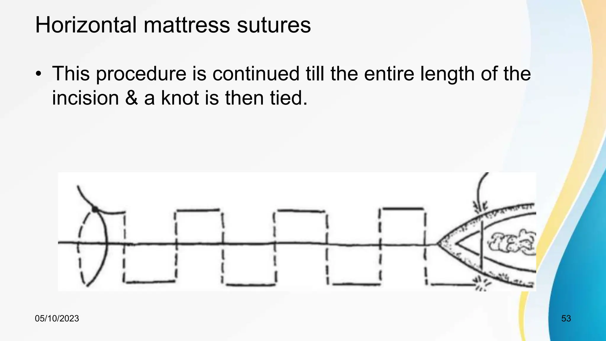 Horizontal mattress sutures
• This procedure is continued till the entire length of the
incision & a knot is then tied.
05/10/2023 53
 