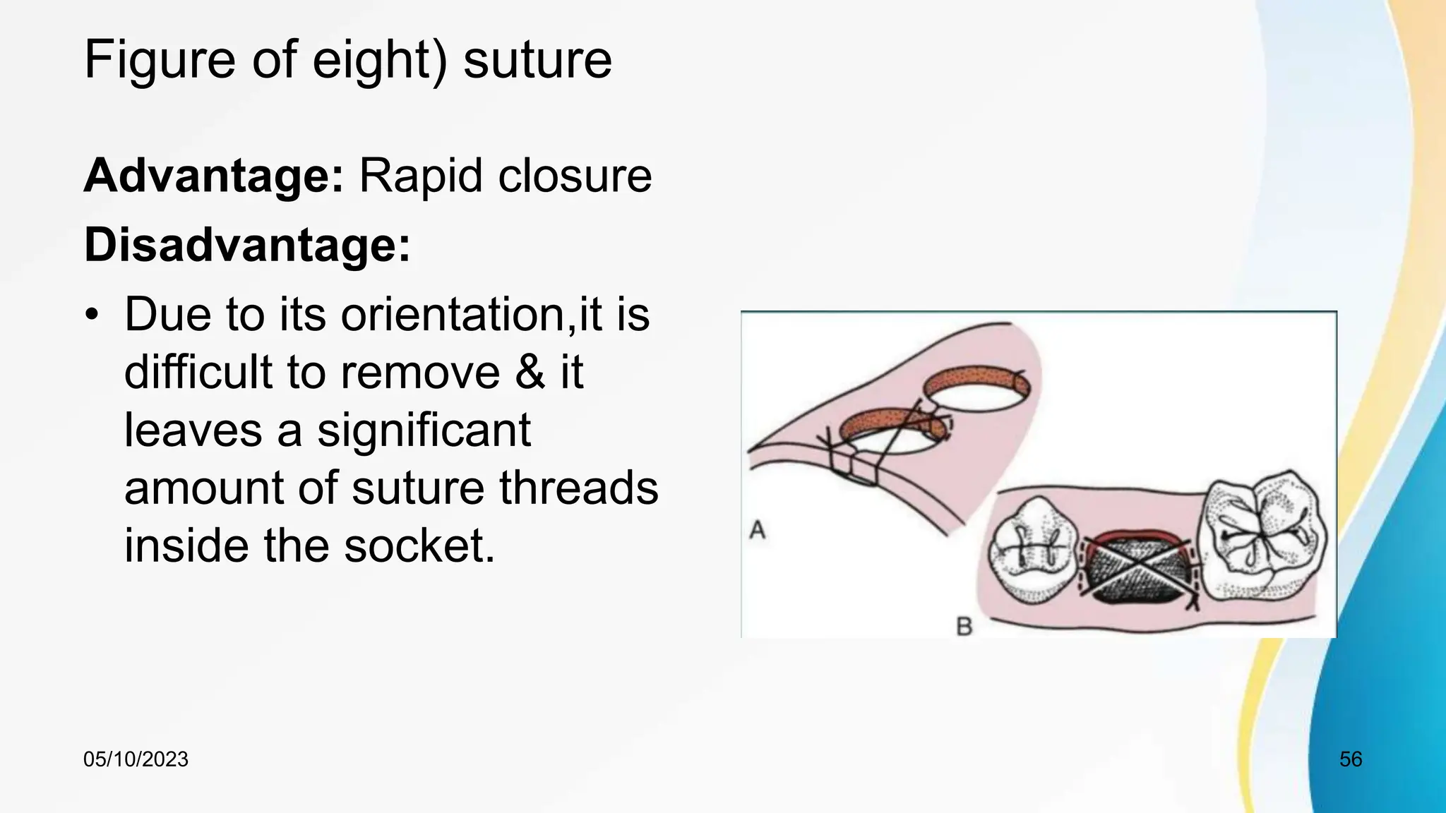 Figure of eight) suture
Advantage: Rapid closure
Disadvantage:
• Due to its orientation,it is
difficult to remove & it
leaves a significant
amount of suture threads
inside the socket.
05/10/2023 56
 