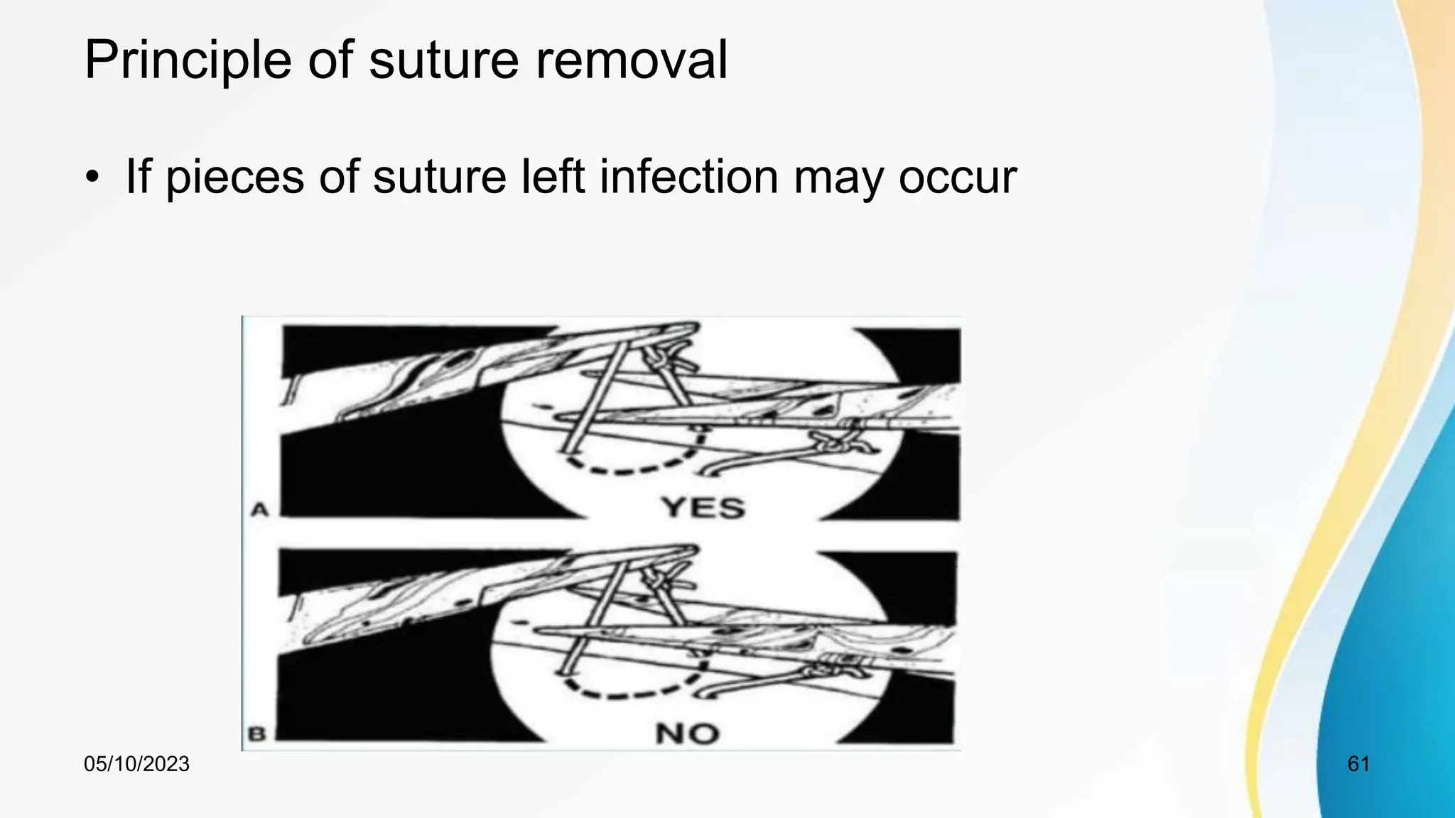 Principle of suture removal
• If pieces of suture left infection may occur
05/10/2023 61
 