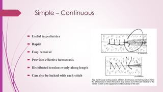 Simple – Continuous
 Useful in pediatrics
 Rapid
 Easy removal
 Provides effective hemostasis
 Distributed tension evenly along length
 Can also be locked with each stitch
 