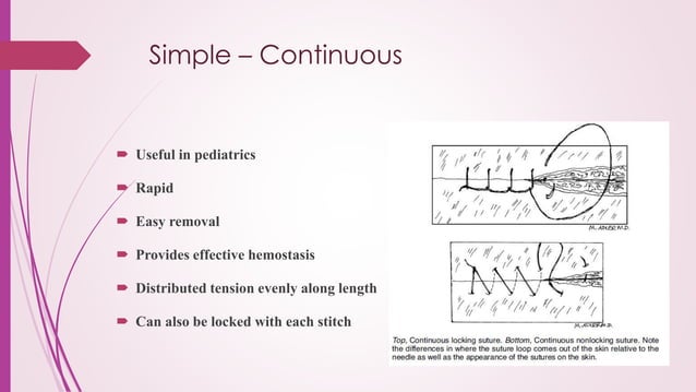 Sutures / Needles & Knots | PPTX