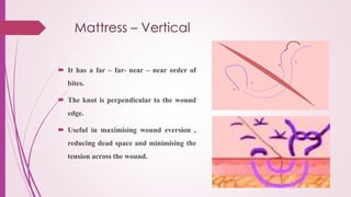 Mattress – Vertical
 It has a far – far- near – near order of
bites.
 The knot is perpendicular to the wound
edge.
 Useful in maximising wound eversion ,
reducing dead space and minimising the
tension across the wound.
 