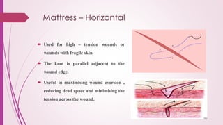Mattress – Horizontal
 Used for high – tension wounds or
wounds with fragile skin.
 The knot is parallel adjacent to the
wound edge.
 Useful in maximising wound eversion ,
reducing dead space and minimising the
tension across the wound.
 