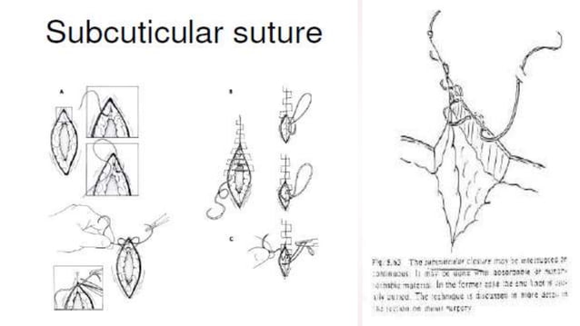 Sutures / Needles & Knots | PPTX