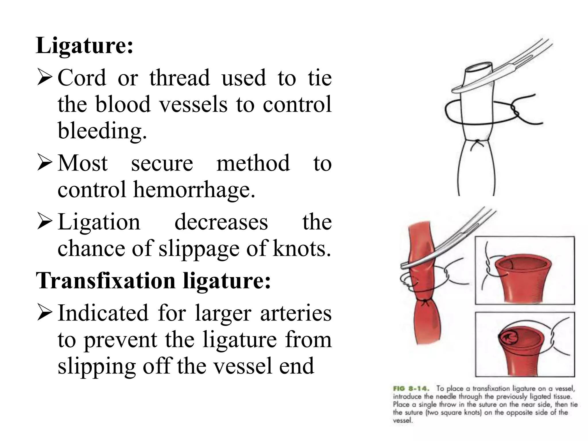 Ligature:
Cord or thread used to tie
the blood vessels to control
bleeding.
Most secure method to
control hemorrhage.
Ligation decreases the
chance of slippage of knots.
Transfixation ligature:
Indicated for larger arteries
to prevent the ligature from
slipping off the vessel end
 
