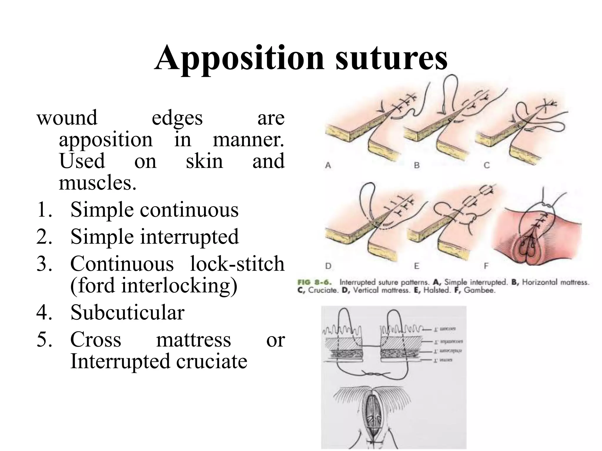 Apposition sutures
wound edges are
apposition in manner.
Used on skin and
muscles.
1. Simple continuous
2. Simple interrupted
3. Continuous lock-stitch
(ford interlocking)
4. Subcuticular
5. Cross mattress or
Interrupted cruciate
 