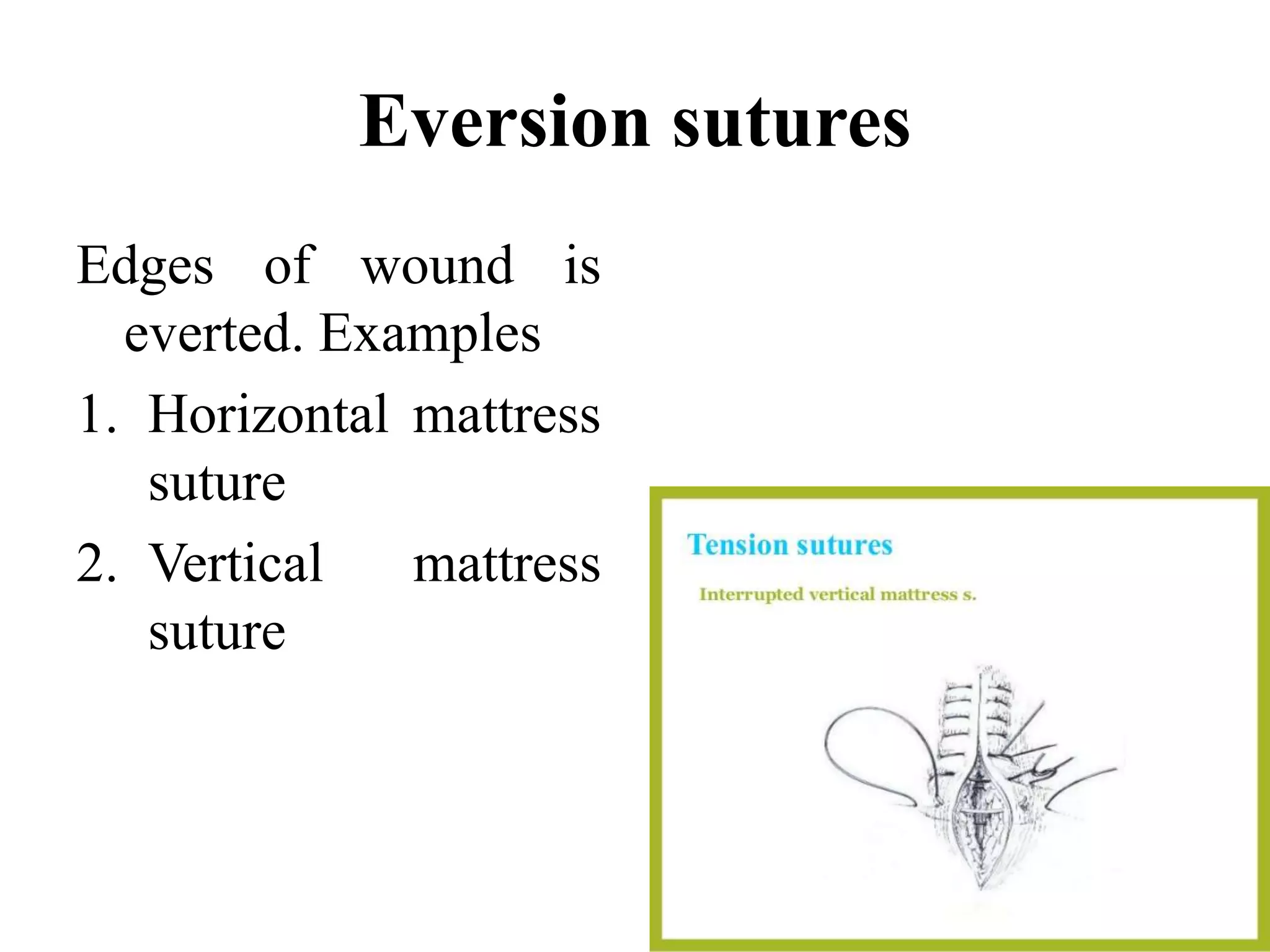 Eversion sutures
Edges of wound is
everted. Examples
1. Horizontal mattress
suture
2. Vertical mattress
suture
 