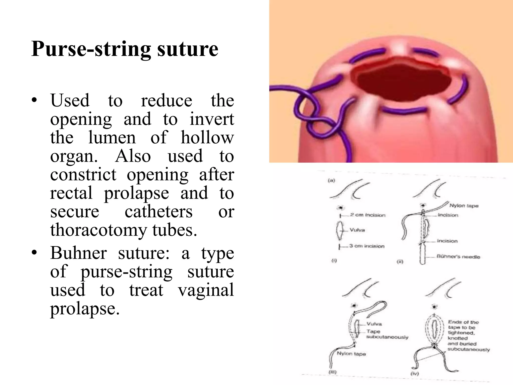 Purse-string suture
• Used to reduce the
opening and to invert
the lumen of hollow
organ. Also used to
constrict opening after
rectal prolapse and to
secure catheters or
thoracotomy tubes.
• Buhner suture: a type
of purse-string suture
used to treat vaginal
prolapse.
 