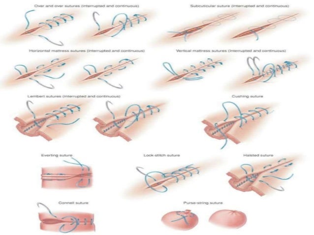 Sutures, sutures materials and suturing patterns