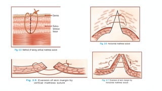 Comprehensive Guide to Sutures and Suturing Techniques in Surgery | PPTX
