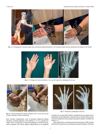 Suture Suspension Sling Arthroplasty for Thumb CMC Joint Arthritis ...