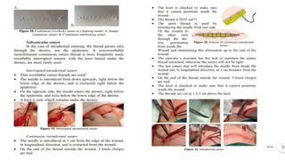 Suparma File Surgery Suture techniques by souparno mandal dr jimsh | PPTX