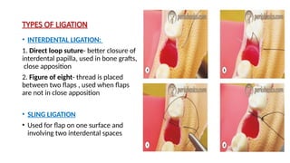 Types Of Ligation SUTURE TECHNIQUES used in dentistry . . | PPTX