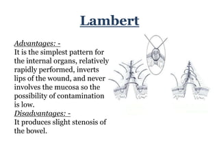 Lembert suture deals