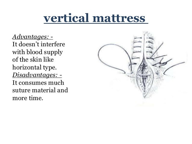 suture patterns
