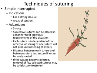 Techniques of suturing
• Simple interrupted
– Indications
• For a strong closure
• Areas of tension
– Advantages
• Strong
• Successive sutures can be placed in
a manner to fit individual
requirements of the situation
• Each suture is independent of the
other,so loosening of one suture will
not produce loosening of others
• Distance between each suture and
between suture and suture line can
be easily varied
• If the wound become infected,
removal of few selected sutures may
be satisfactory treatment
 