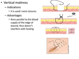 • Vertical mattress
– Indications
• It is used I neck closures
– Advantages
• Runs parallel to the blood
supply of the edge of
wound, thus doesn’t
interfere with healing
 