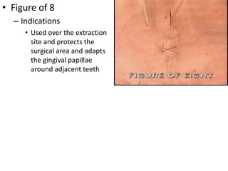 • Figure of 8
– Indications
• Used over the extraction
site and protects the
surgical area and adapts
the gingival papillae
around adjacent teeth
 