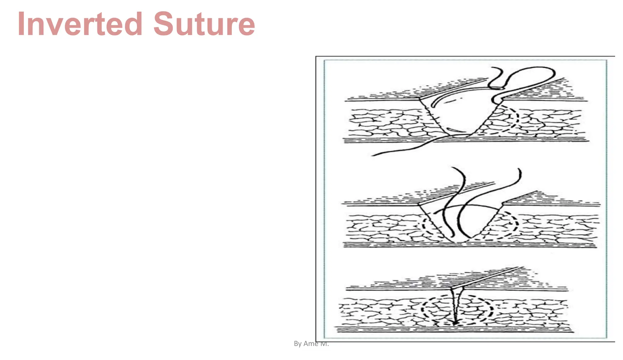 Inverted Suture
By Ame M.
 