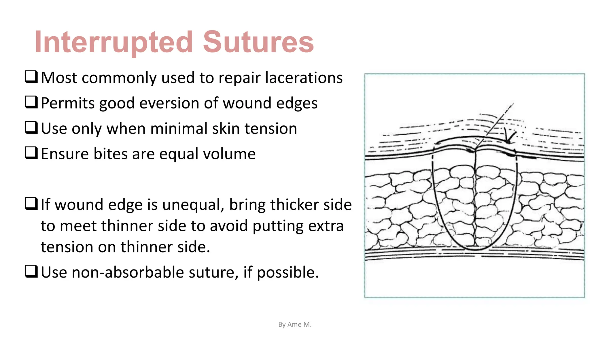 Interrupted Sutures
Most commonly used to repair lacerations
Permits good eversion of wound edges
Use only when minimal skin tension
Ensure bites are equal volume
If wound edge is unequal, bring thicker side
to meet thinner side to avoid putting extra
tension on thinner side.
Use non-absorbable suture, if possible.
By Ame M.
 