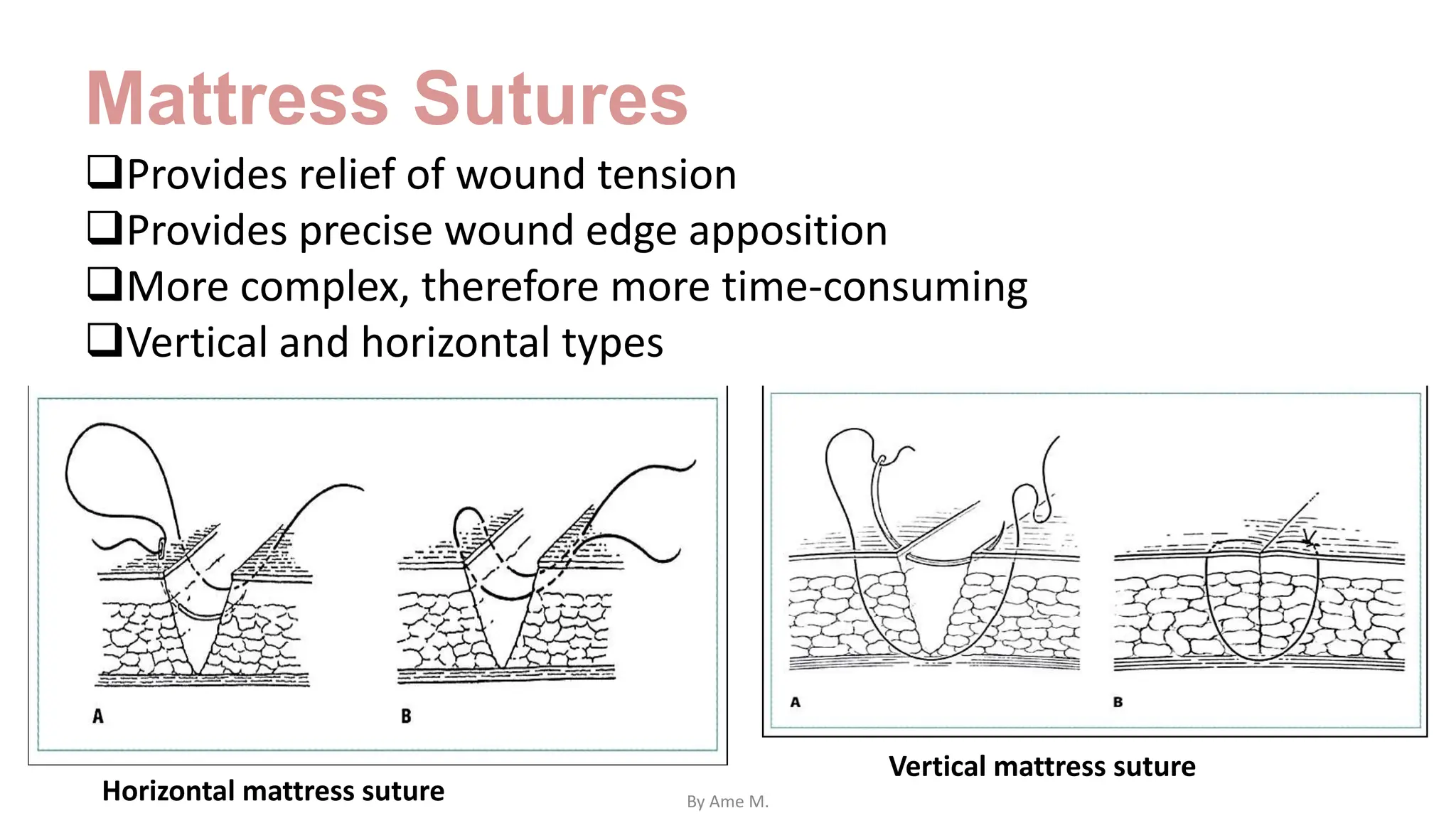 Mattress Sutures
Provides relief of wound tension
Provides precise wound edge apposition
More complex, therefore more time-consuming
Vertical and horizontal types
Vertical mattress suture
Horizontal mattress suture By Ame M.
 