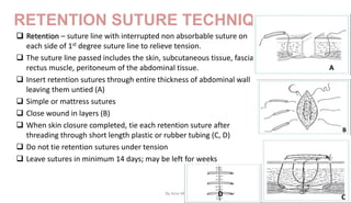 RETENTION SUTURE TECHNIQUES
 Retention – suture line with interrupted non absorbable suture on
each side of 1st degree suture line to relieve tension.
 The suture line passed includes the skin, subcutaneous tissue, fascia
rectus muscle, peritoneum of the abdominal tissue.
 Insert retention sutures through entire thickness of abdominal wall
leaving them untied (A)
 Simple or mattress sutures
 Close wound in layers (B)
 When skin closure completed, tie each retention suture after
threading through short length plastic or rubber tubing (C, D)
 Do not tie retention sutures under tension
 Leave sutures in minimum 14 days; may be left for weeks
A
B
By Ame M.
C
D
 
