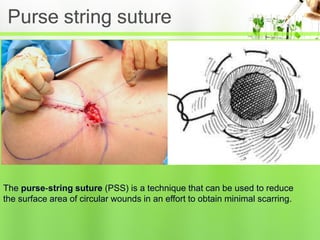 How To String Suture Suturing Dr Bijendra Shah ppt | PPT