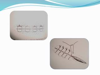 Suturing Tree SUTURING MATERIALS & TECHNIQUES OF SUTURING.pptx